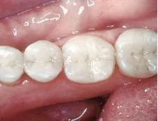 After dental treatment