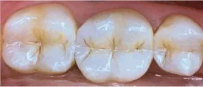 After dental treatment