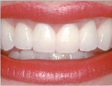 After dental treatment