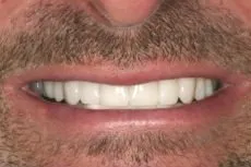 After dental treatment