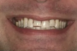 Before dental treatment