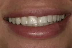 After dental treatment
