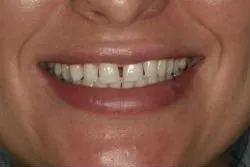 Before dental treatment